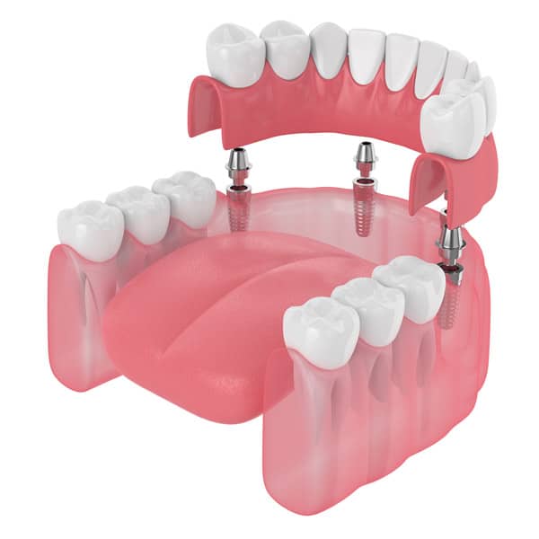 Trefoil Lower Arch Prosthesis In Marysville - Dentistry At Marysville