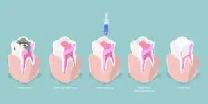 root canal