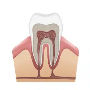 root canal