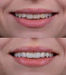 veneers Marysville WA