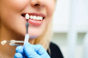 dental veneers longevity